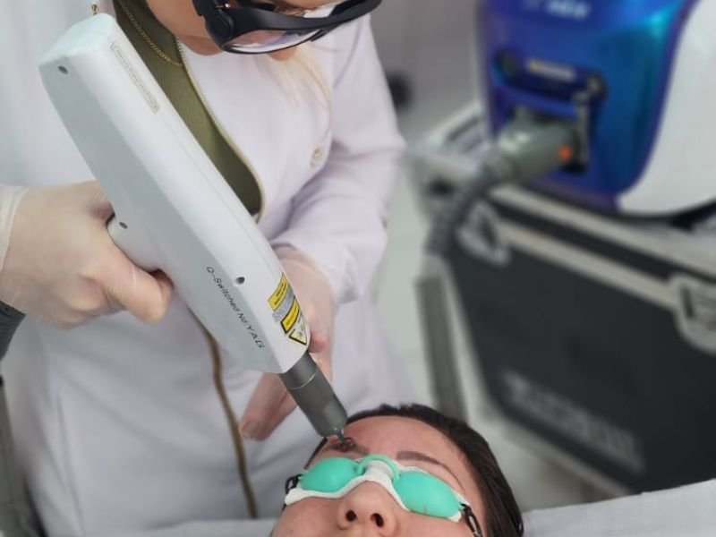 Curso de Remocao a Laser de Micropigmentacao e Tatuagem Bonus Black Peel em Curitiba