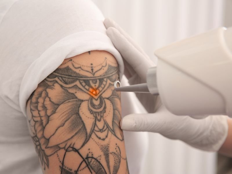 Curso de Remocao de Tatuagem