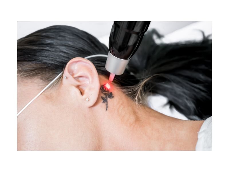 Remocao de Tatuagem em Curitiba