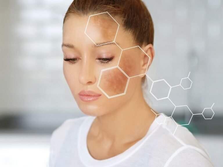 Tratamento de Melasma em Curitiba