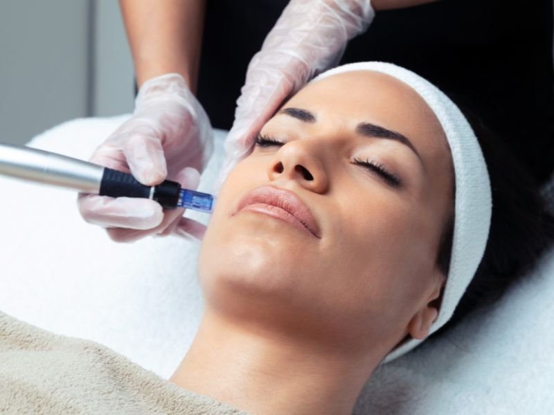 Curso de Microagulhamento Facial em Curitiba