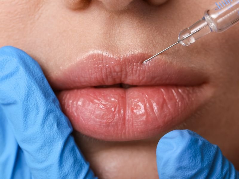 Curso de preenchimento labial em Curitiba