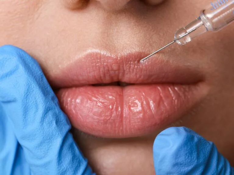 Curso de preenchimento labial em Curitiba
