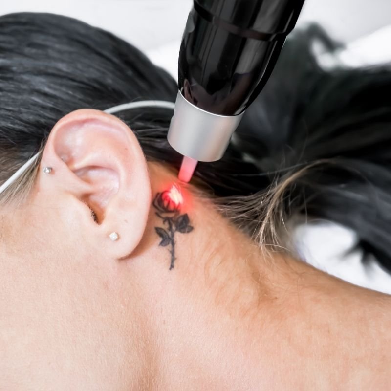 Curso Remocao de Micropigmentacao e Tatuagem a Laser Curitiba